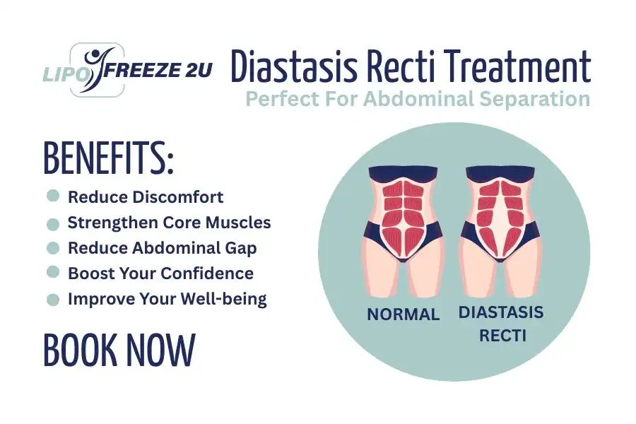 Benefits of body toning treatment Reigate for Diastasis recti