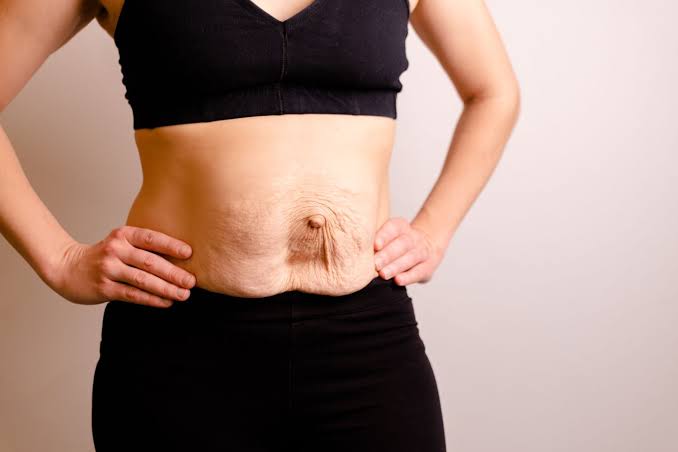 Is Surgery Really the Only Way to Repair Diastasis Recti Reigate?