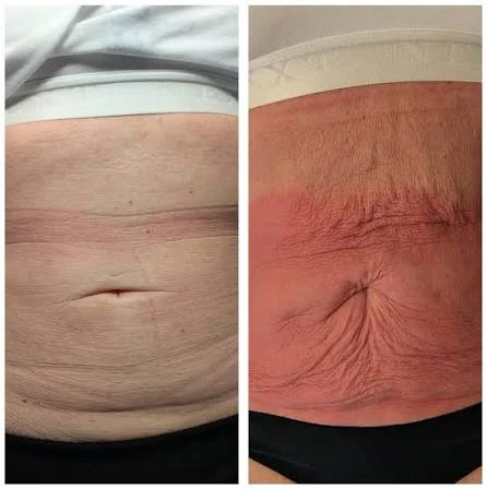 How Does RF Microneedling Improve Crepey, Thin and Uneven Skin Texture Reigate?