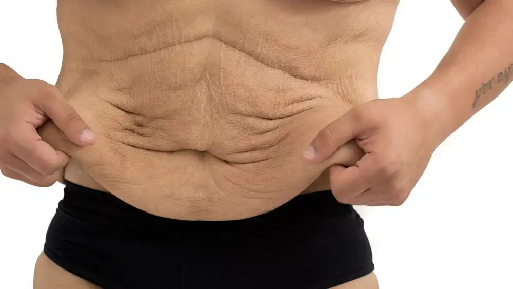 RF Microneedling for Loose Skin: How Can It Help Tighten and Reshape the Skin Reigate?